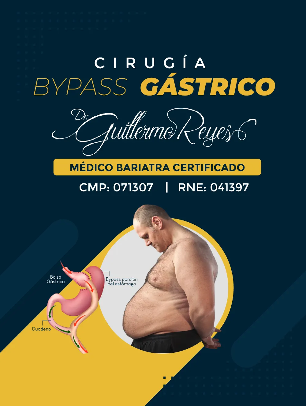 Bypass Gástrico móbil